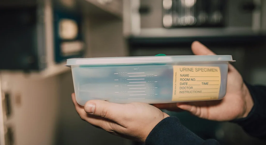 Hands holding a urine specimen container labeled URINE SPECIMEN
